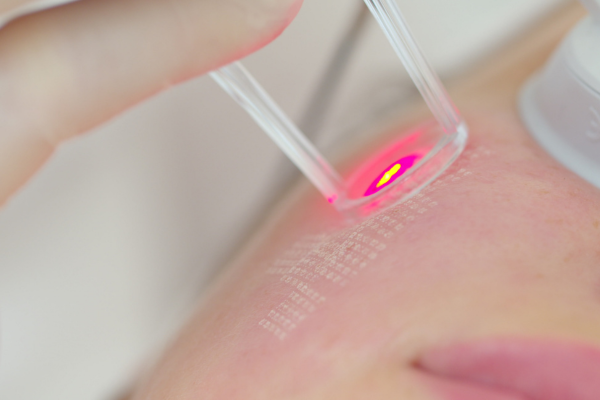 Best Skin Resurfacing Treatment in Pimpri Chinchwad, Pune